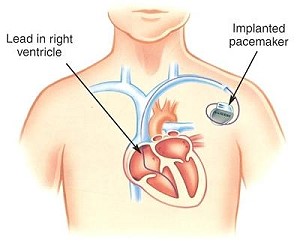 Advantages of double chamber heart pacemaker vs. single chamber pacemaker